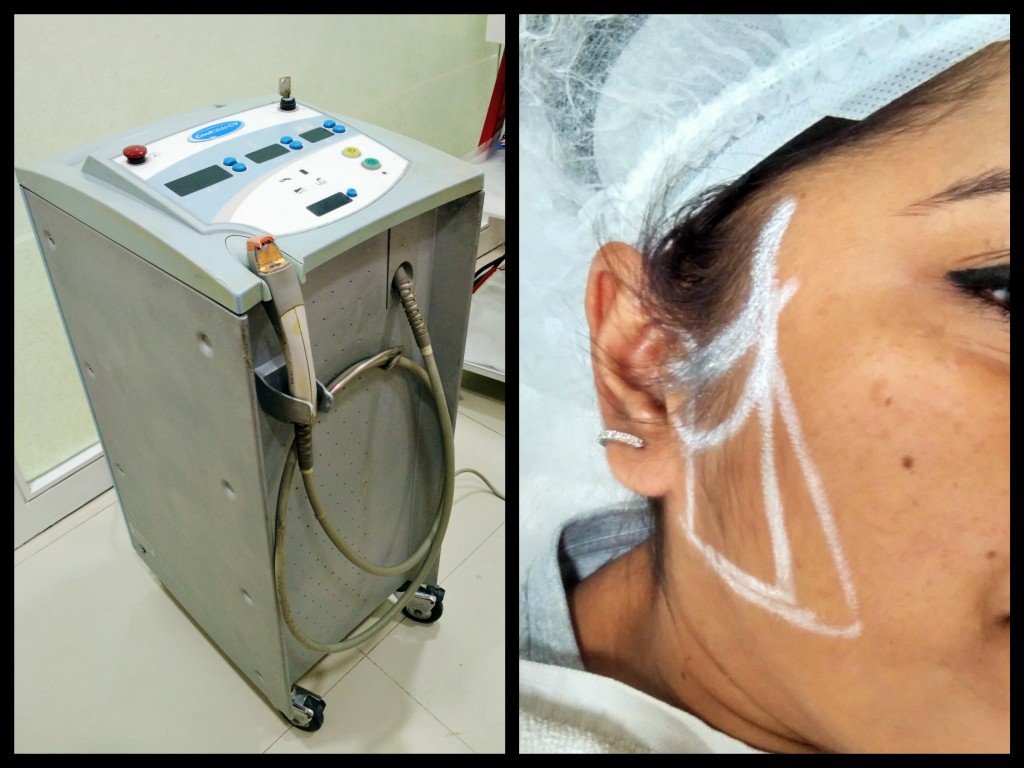 The Laser Machine and my face marked for the treatment.